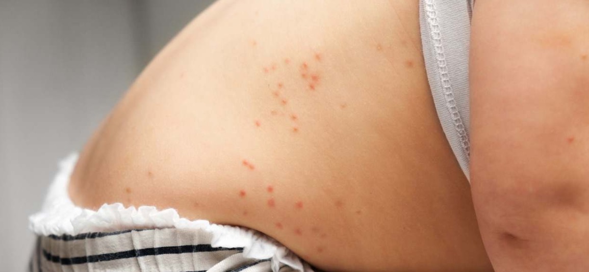 Emiten un alerta epidemiológica por casos de sarampión notificados por la Nación